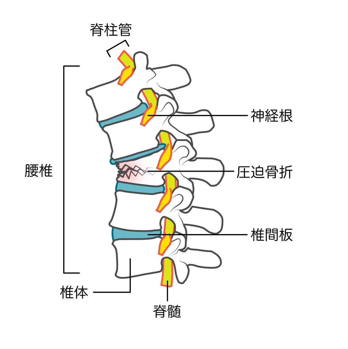 脊椎疾患　圧迫骨折