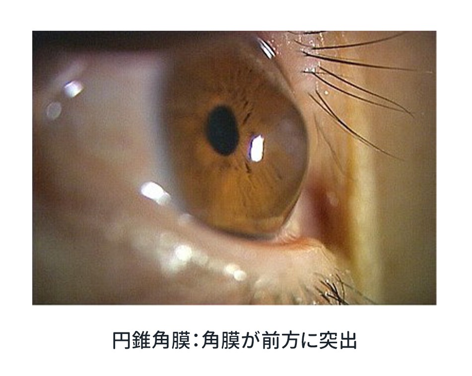 円錐角膜1