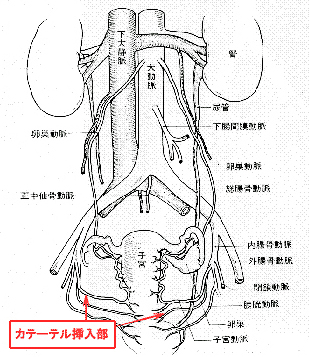 放射線科子宮筋腫