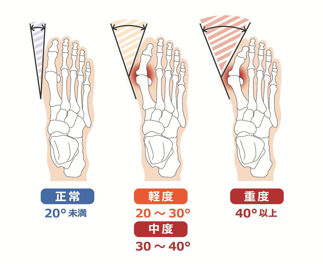 外反母趾重症度