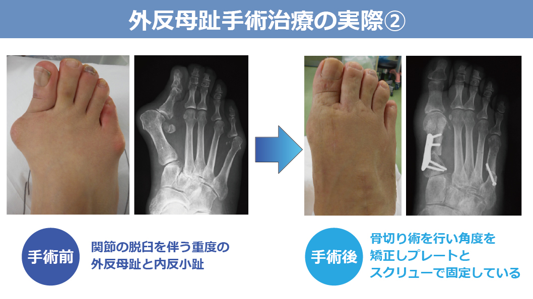 外反母趾手術治療の実際②