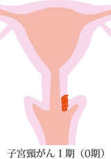 子宮頸がんI期0期