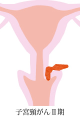 子宮頸がんII期