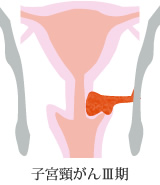 子宮頸がんIII期
