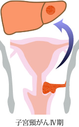 子宮頸がんIV期