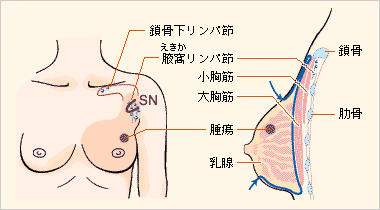 乳房切除術（胸筋温存乳房切除術）