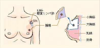乳房扇状部分切除術