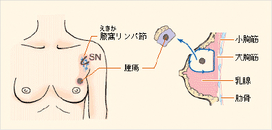 乳房円状部分切除術