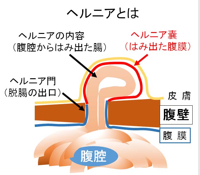 ヘルニアとは