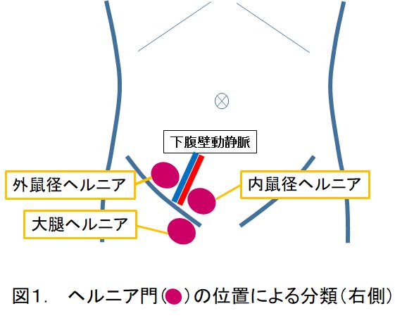 ヘルニア門の位置による分類.jpg