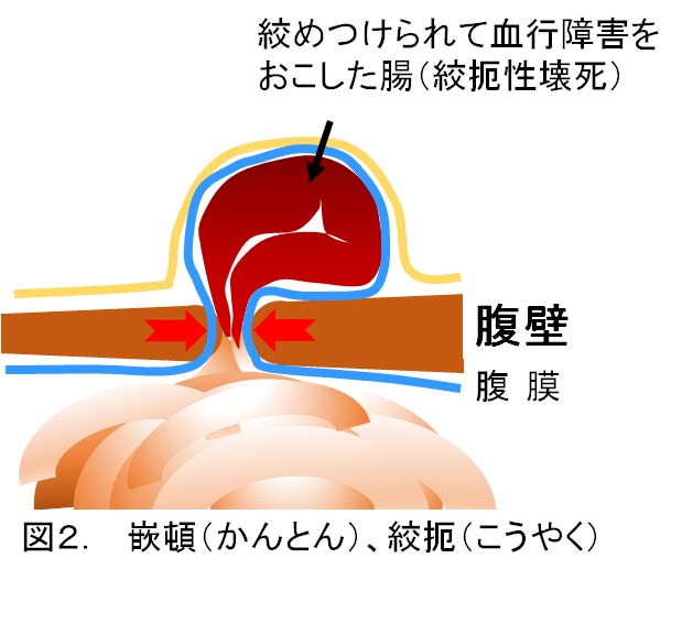 鼠径部ヘルニアの症状