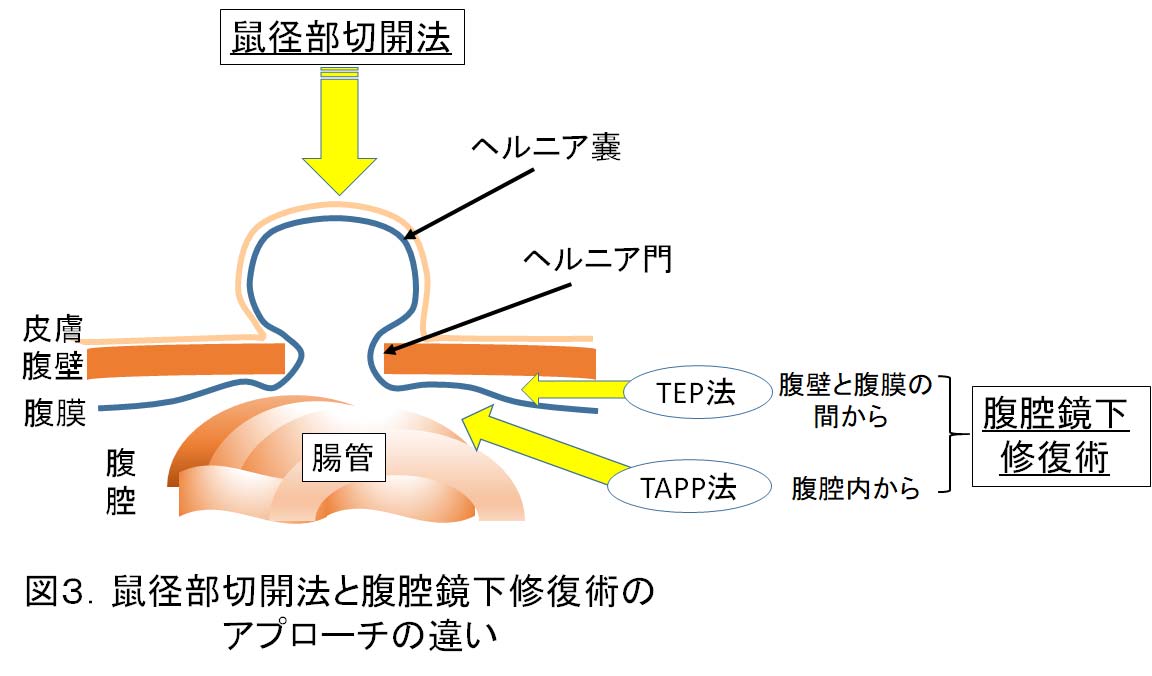 鼠径部切開法