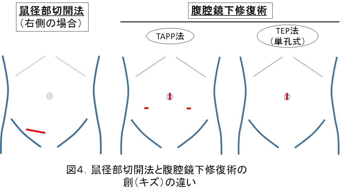 腹腔鏡下修復術