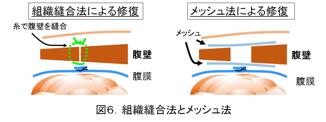 図６組織縫合法とメッシュ