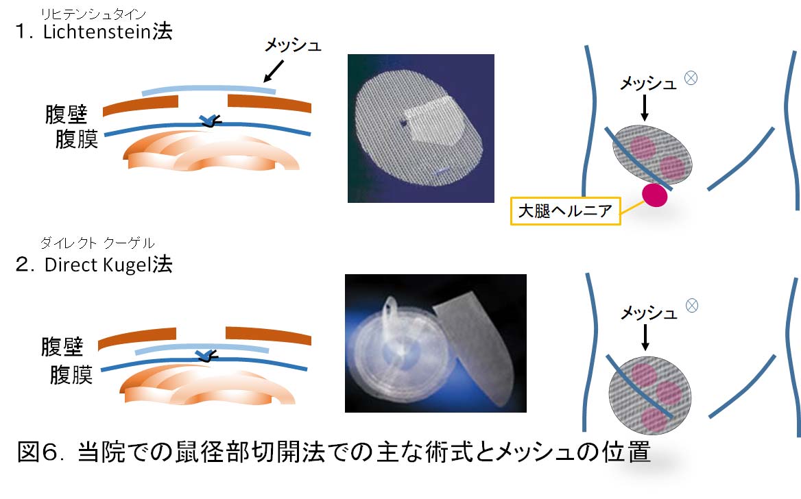 図６当院での鼠径部切開法での主な術式とメッシュの位置