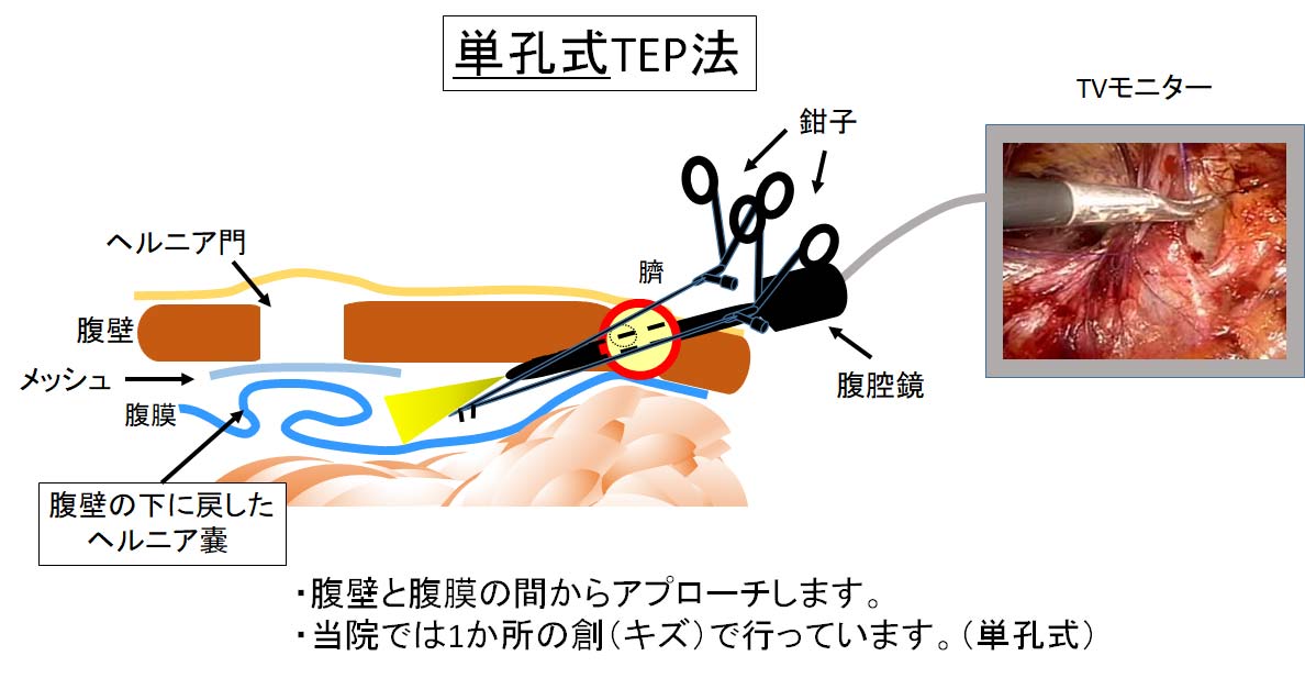 単孔式TEP法