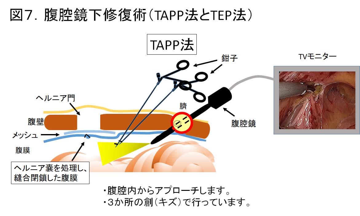 図7腹腔鏡下修復術（TAPP法とTEP法）