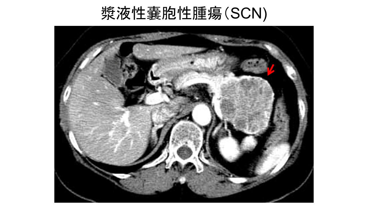 漿液性嚢胞性腫瘍（SCN）