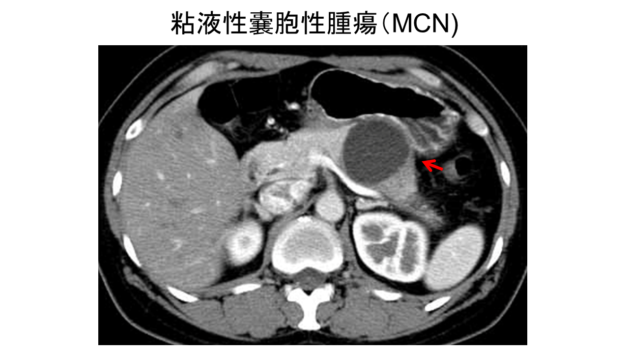 粘液性嚢胞性腫瘍（MCN）