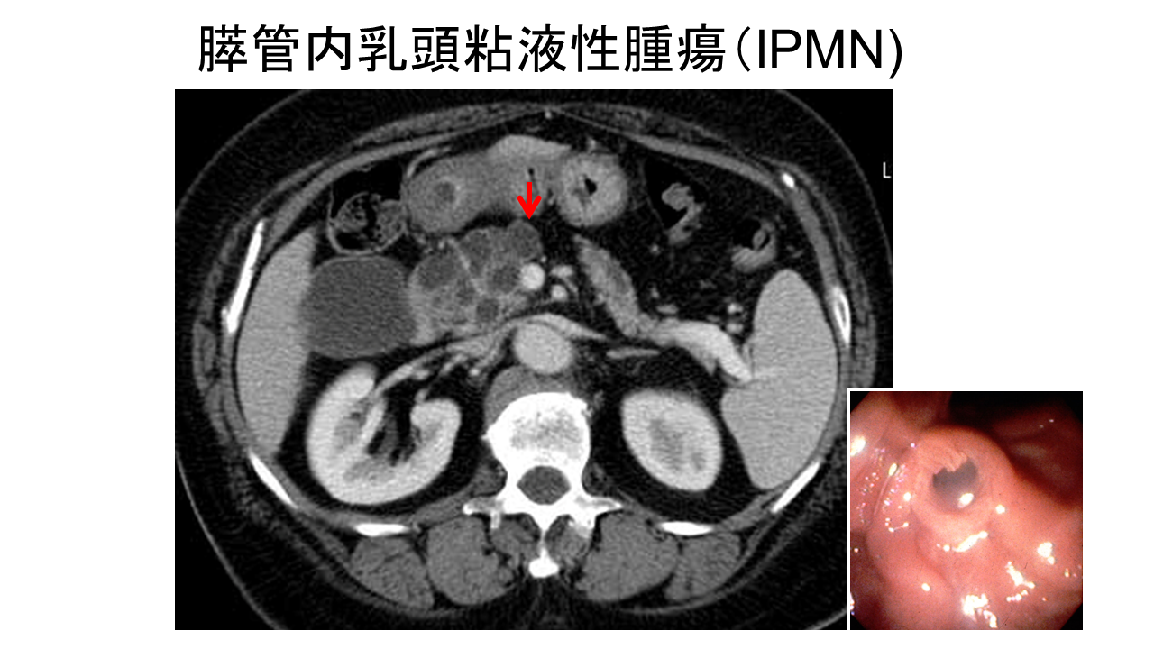 手術を検討する必要のある分枝型IPMN