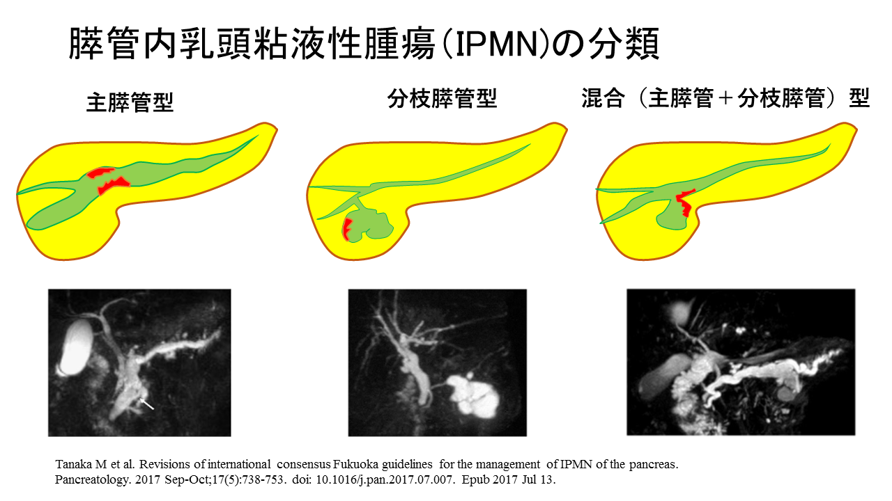 膵管内乳頭粘液性腫瘍（IPMN）