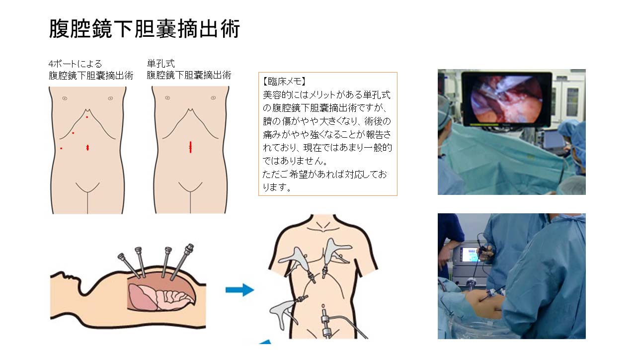 腹腔鏡下胆嚢摘出術