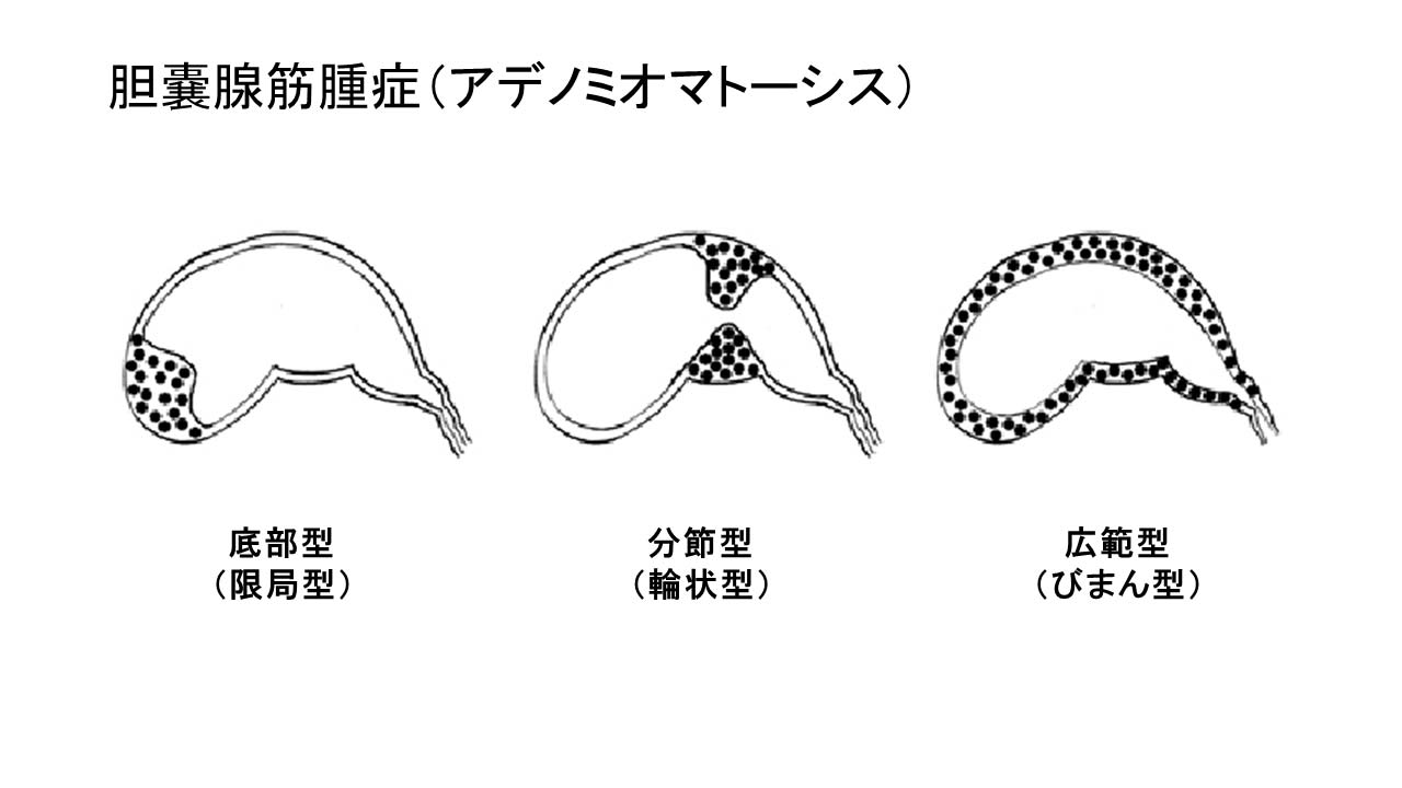 胆嚢腺筋腫症（アデノミオマトーシス）