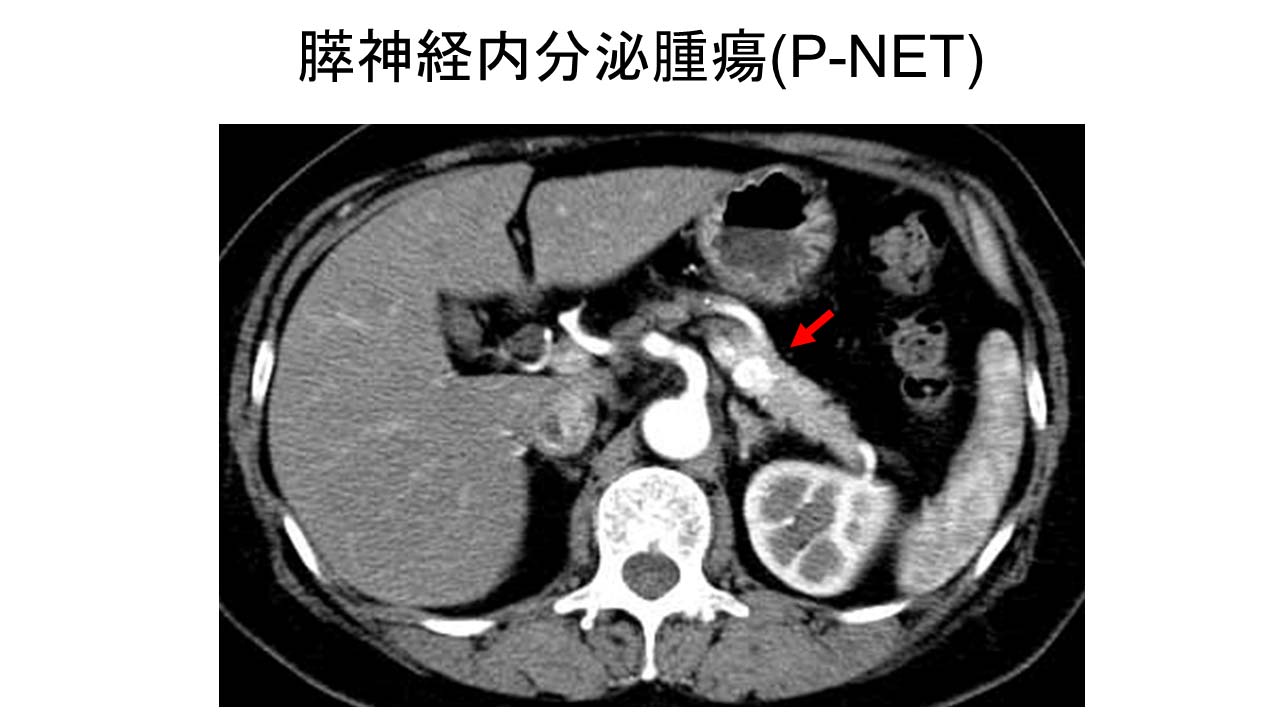 膵神経内分泌腫瘍