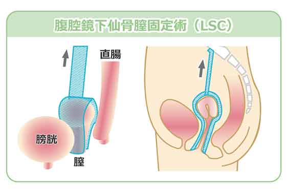 骨盤臓器脱|倉敷成人病センター ひとりひとりにやさしく 最良の医療を