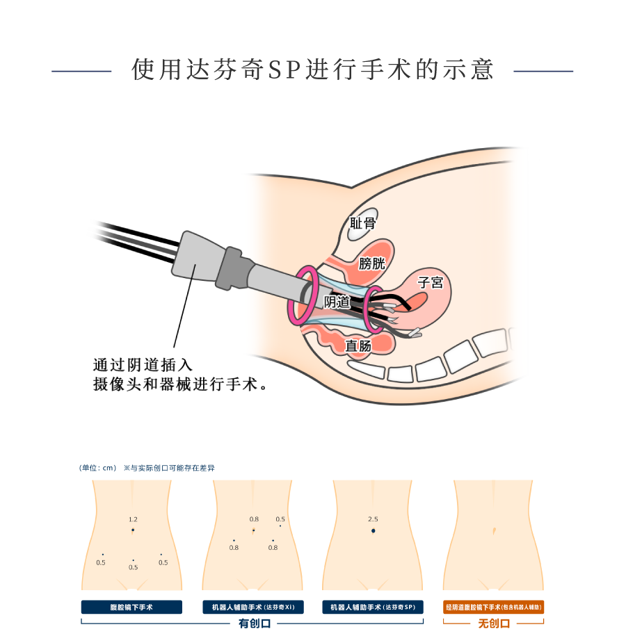 使用达芬奇SP进行手术的示意