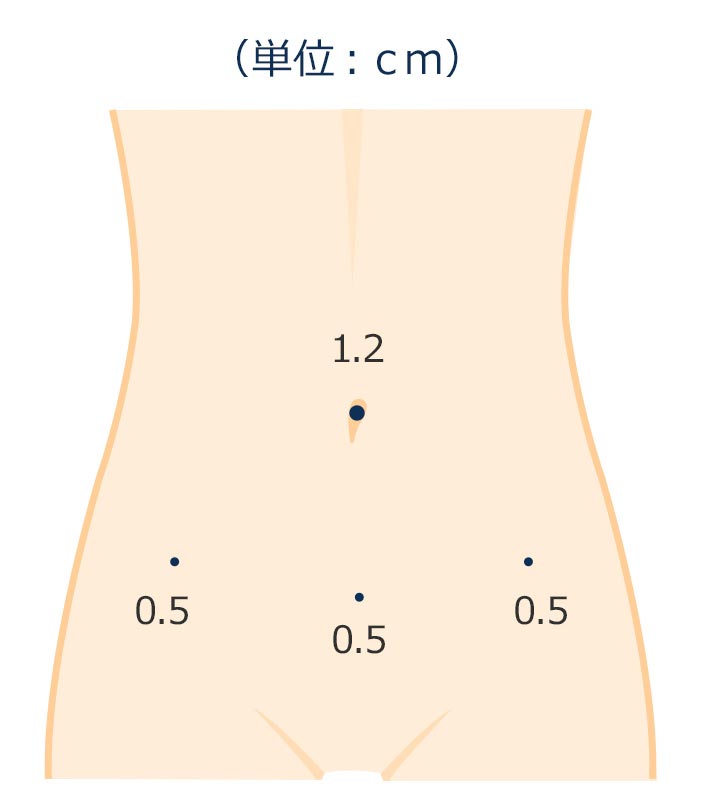 腹腔鏡下手術