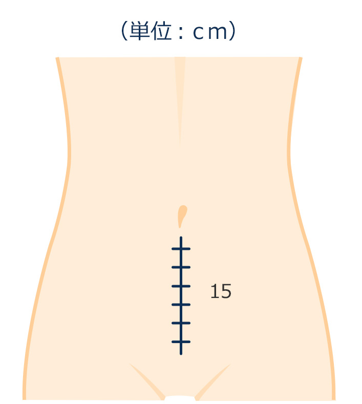 開腹手術